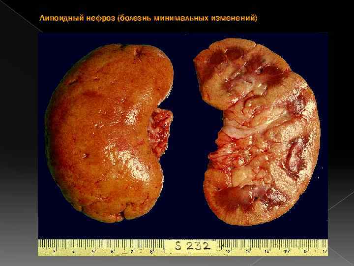 Липоидный нефроз (болезнь минимальных изменений) 