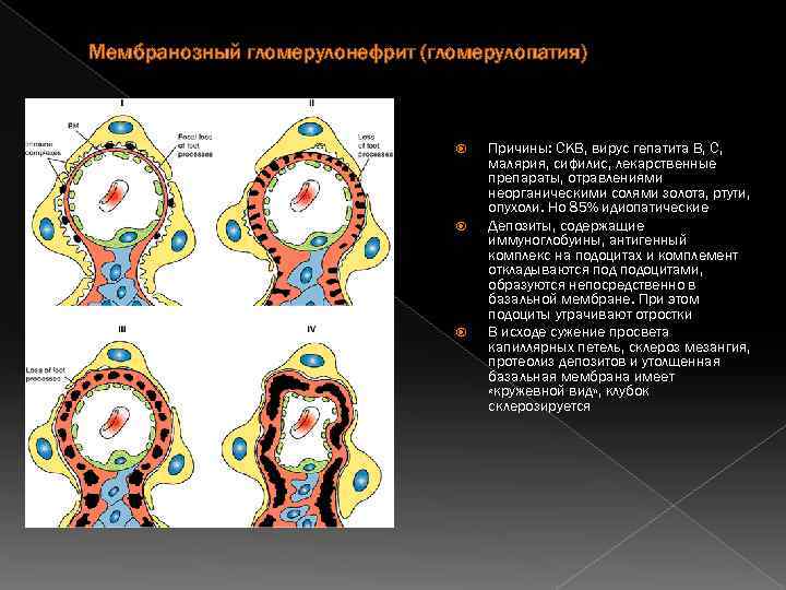 Мембранозный гломерулонефрит (гломерулопатия) Причины: СКВ, вирус гепатита В, С, малярия, сифилис, лекарственные препараты, отравлениями