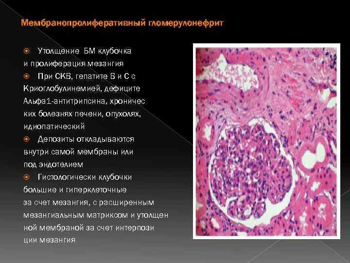 Мембранопролиферативный гломерулонефрит Утолщение БМ клубочка и пролиферация мезангия При СКВ, гепатите В и С