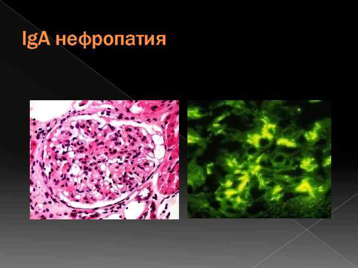 Ig. А нефропатия 