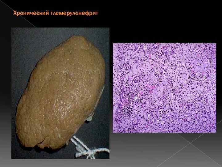 Хронический гломерулонефрит 