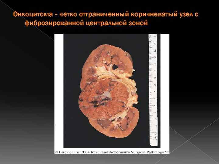 Онкоцитома - четко отграниченный коричневатый узел с фиброзированной центральной зоной 
