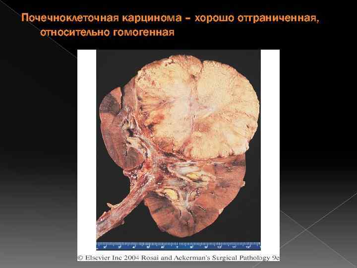 Почечноклеточная карцинома – хорошо отграниченная, относительно гомогенная 