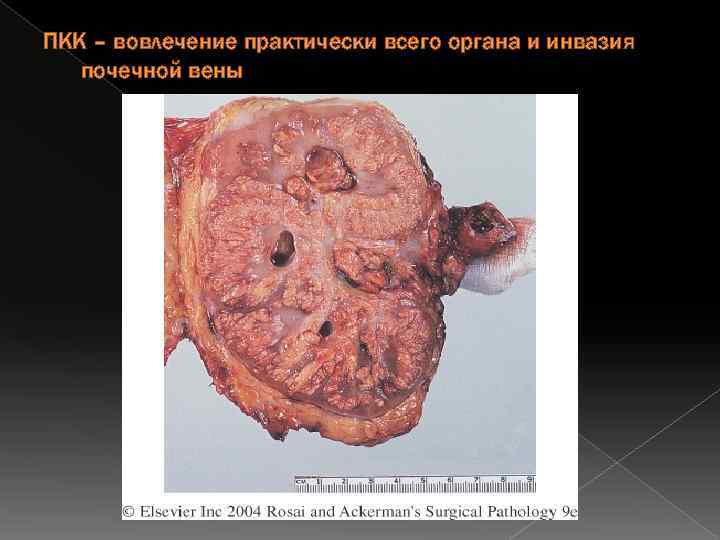 ПКК – вовлечение практически всего органа и инвазия почечной вены 