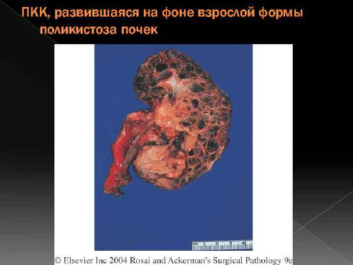 ПКК, развившаяся на фоне взрослой формы поликистоза почек 