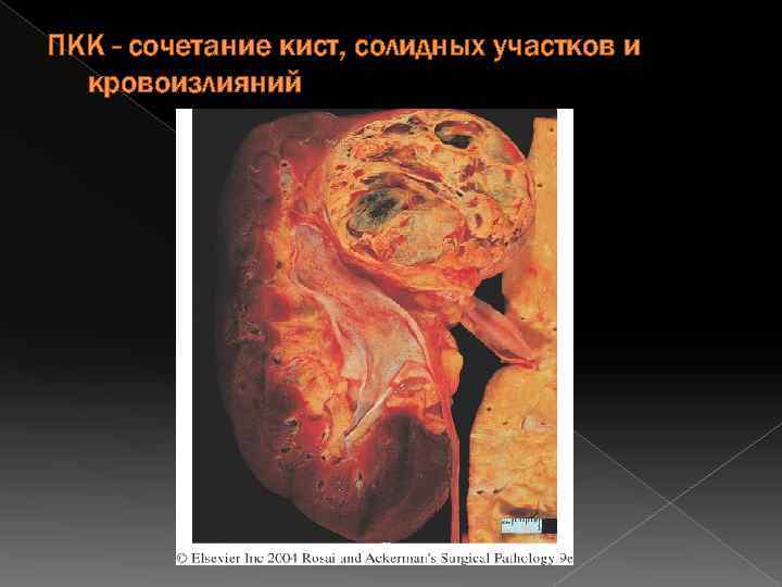 ПКК - сочетание кист, солидных участков и кровоизлияний 