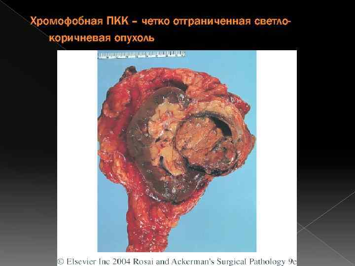Хромофобная ПКК – четко отграниченная светлокоричневая опухоль 