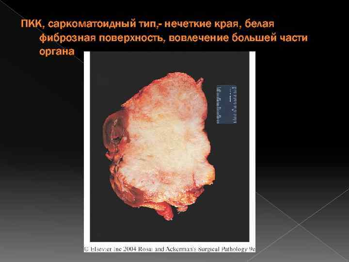 ПКК, саркоматоидный тип, - нечеткие края, белая фиброзная поверхность, вовлечение большей части органа 