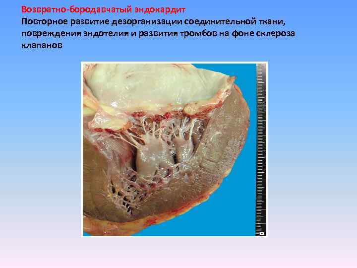 Возвратно-бородавчатый эндокардит Повторное развитие дезорганизации соединительной ткани, повреждения эндотелия и развития тромбов на фоне
