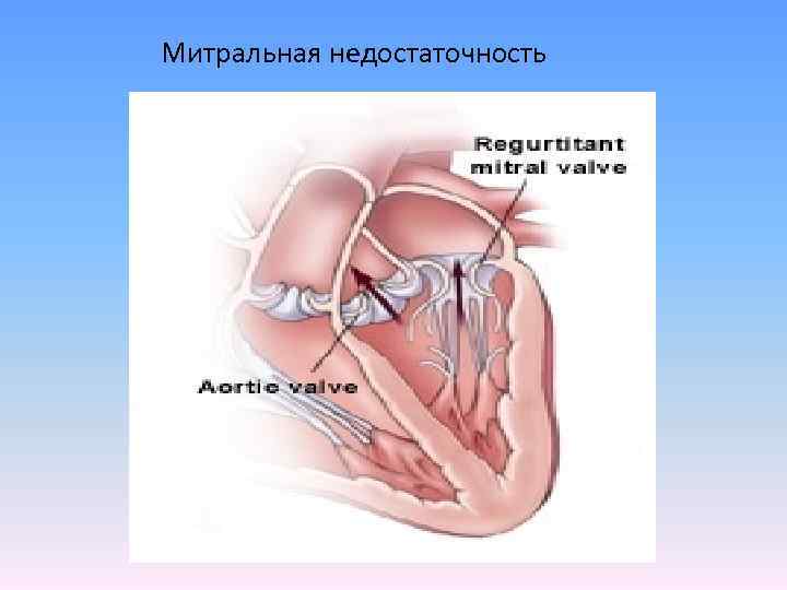 Митральная недостаточность 