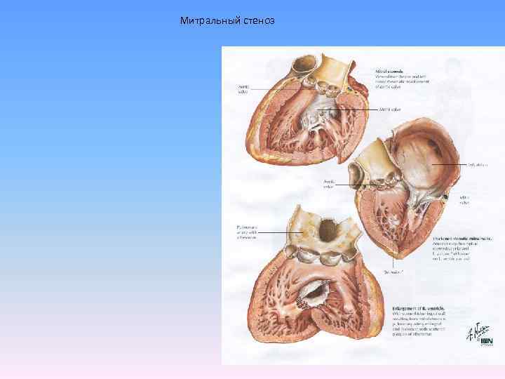 Митральный стеноз 