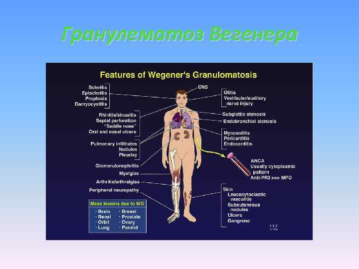 Гранулематоз Вегенера 