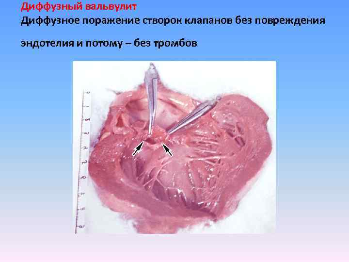 Диффузный вальвулит Диффузное поражение створок клапанов без повреждения эндотелия и потому – без тромбов