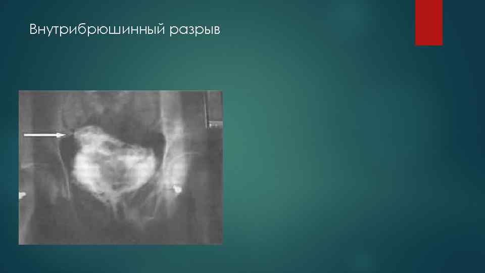 Внутрибрюшинный разрыв 