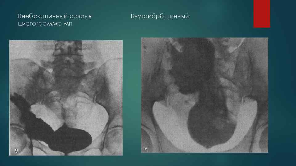 Внебрюшинный разрыв цистограмма мп Внутрибрбшинный 