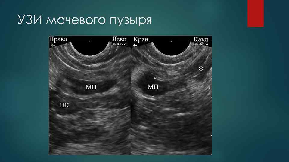 УЗИ мочевого пузыря 