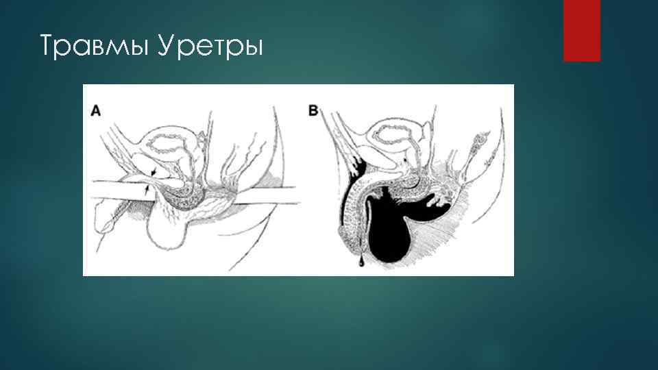 Травмы Уретры 