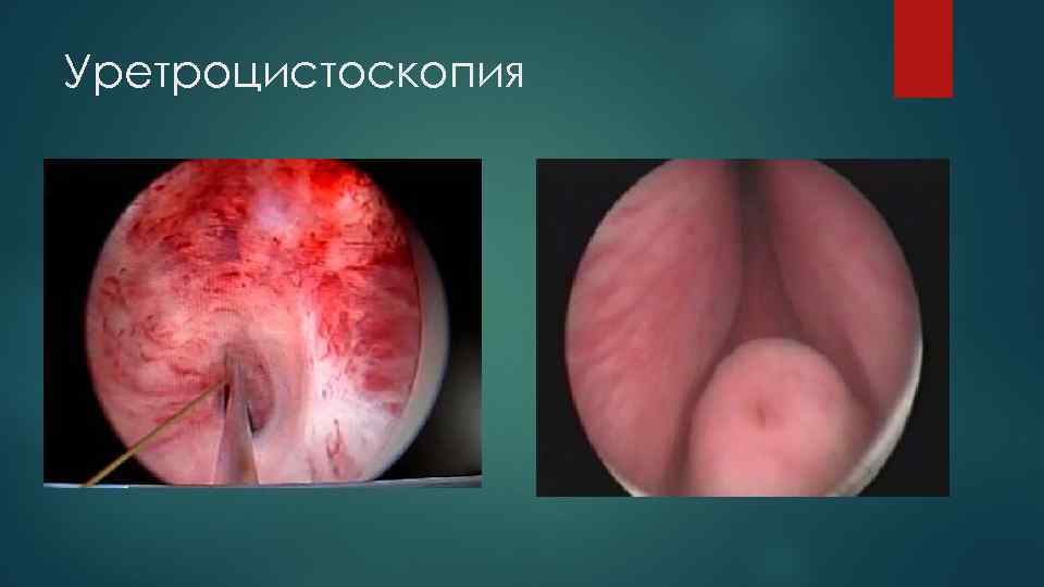 Уретроцистоскопия 
