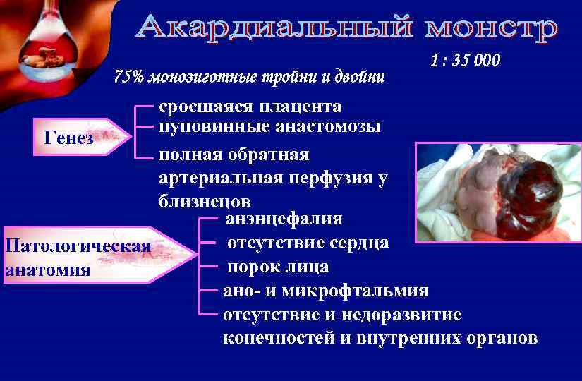 75% монозиготные тройни и двойни 1 : 35 000 сросшаяся плацента пуповинные анастомозы Генез