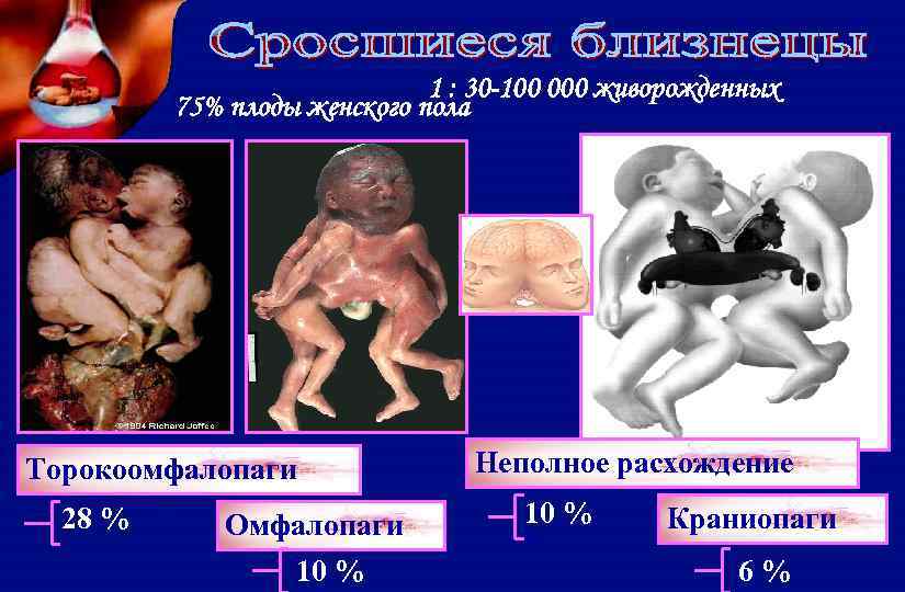 1 : 30 -100 000 живорожденных 75% плоды женского пола Торокоомфалопаги 28 % Омфалопаги