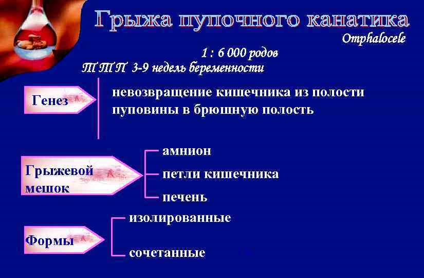 1 : 6 000 родов Т Т П 3 -9 недель беременности Генез невозвращение