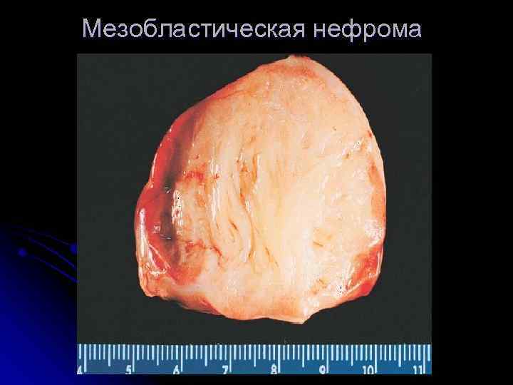 Мезобластическая нефрома 