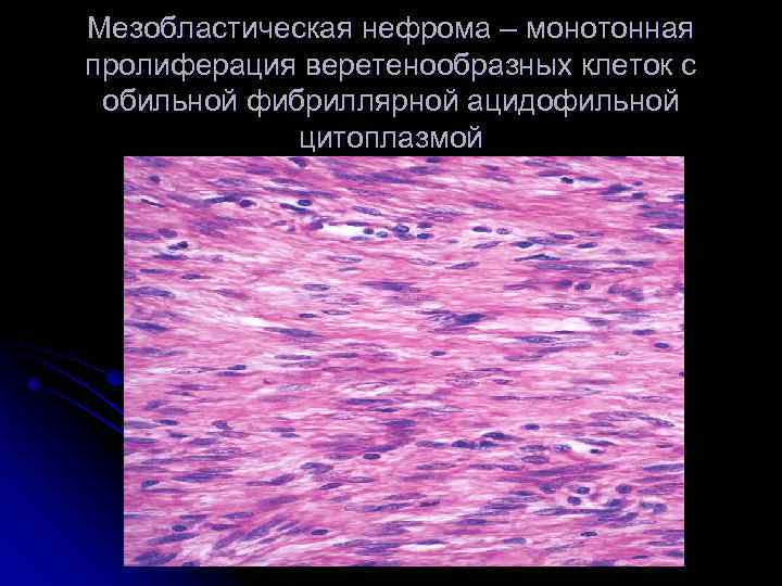 Мезобластическая нефрома – монотонная пролиферация веретенообразных клеток с обильной фибриллярной ацидофильной цитоплазмой 