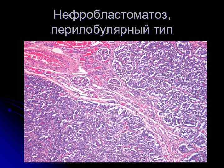 Нефробластоматоз, перилобулярный тип 