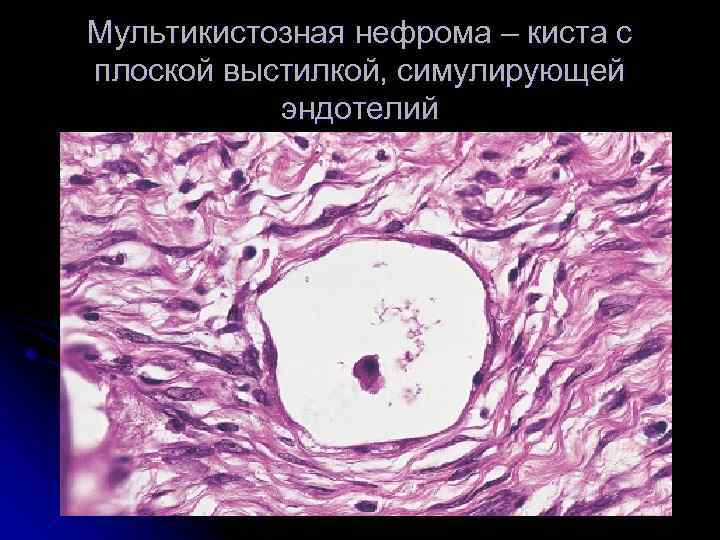 Мультикистозная нефрома – киста с плоской выстилкой, симулирующей эндотелий 