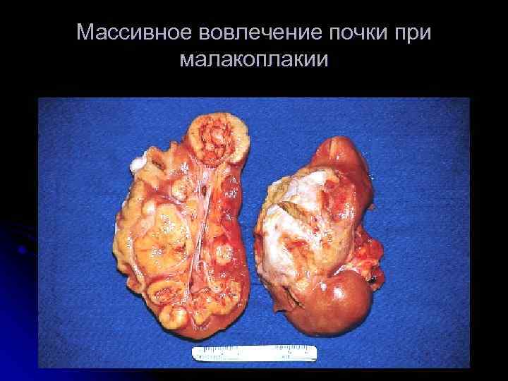 Массивное вовлечение почки при малакоплакии 