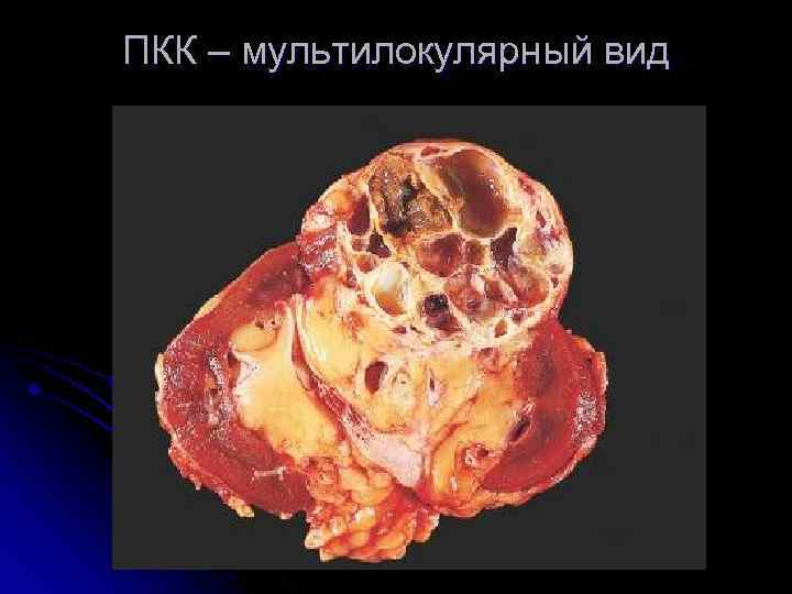 ПКК – мультилокулярный вид 