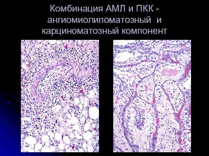 Комбинация АМЛ и ПКК ангиомиолипоматозный и карциноматозный компонент 