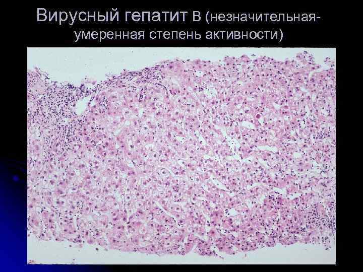 Вирусный гепатит B (незначительнаяумеренная степень активности) 