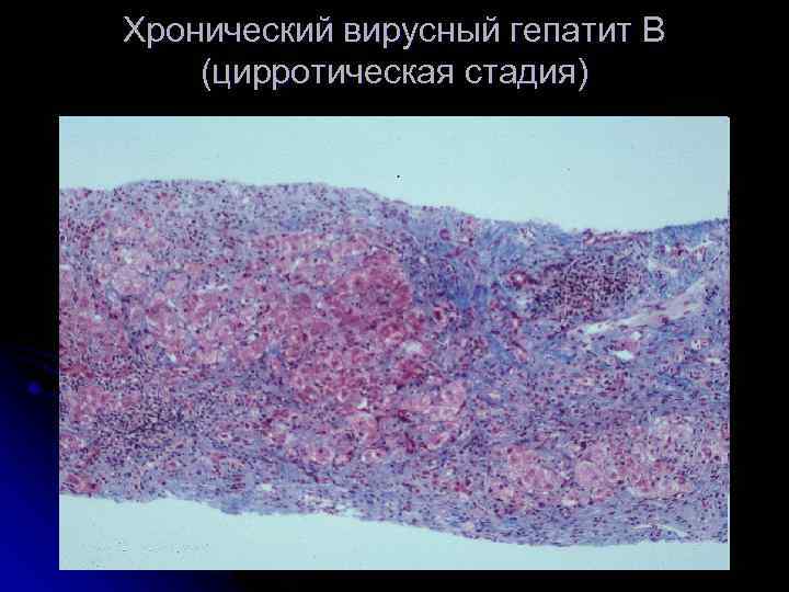 Хронический вирусный гепатит В (цирротическая стадия) 