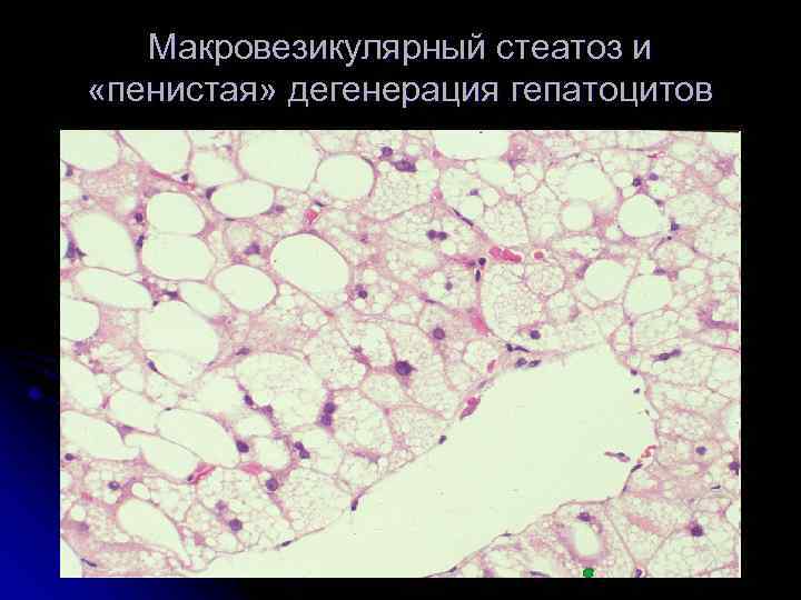 Макровезикулярный стеатоз и «пенистая» дегенерация гепатоцитов 