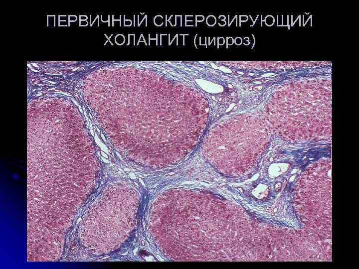 ПЕРВИЧНЫЙ СКЛЕРОЗИРУЮЩИЙ ХОЛАНГИТ (цирроз) 