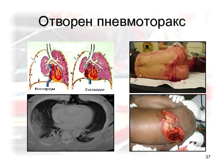 Отворен пневмоторакс 37 