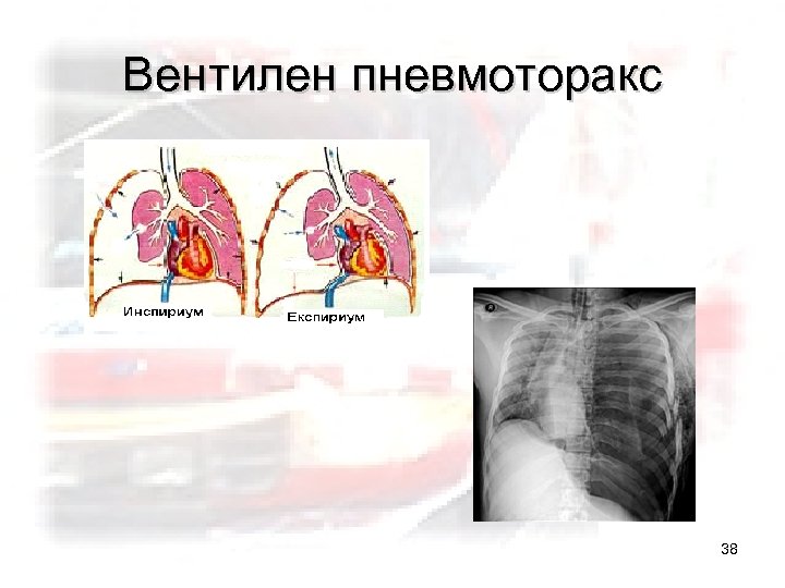 Вентилен пневмоторакс 38 