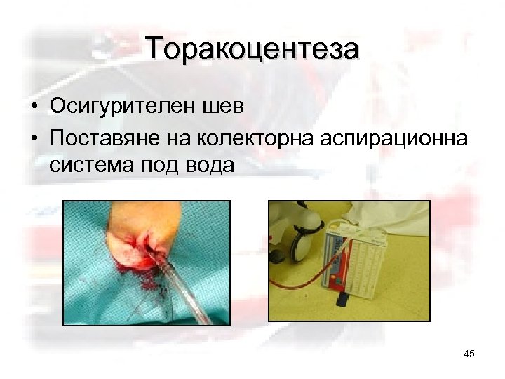 Торакоцентеза • Осигурителен шев • Поставяне на колекторна аспирационна система под вода 45 