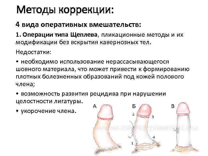 Методы коррекции: 4 вида оперативных вмешательств: 1. Операции типа Щеплева, пликационные методы и их