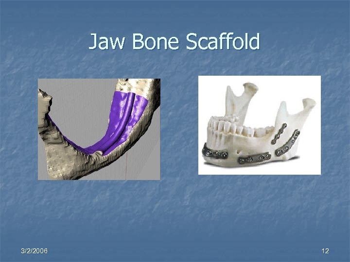 Jaw Bone Scaffold 3/2/2006 12 
