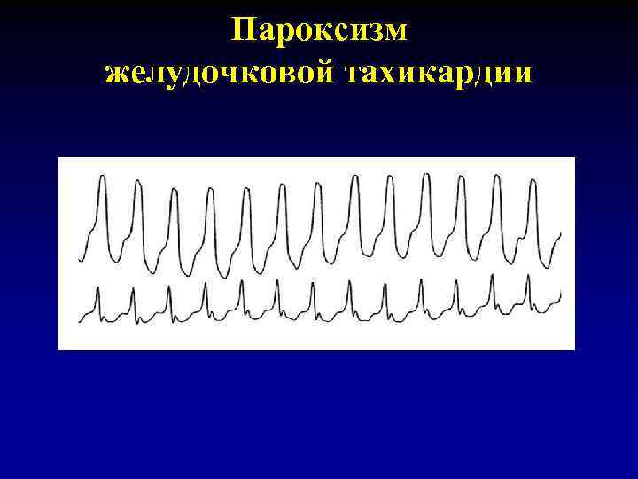 При возникновении пароксизма устойчивой желудочковой тахикардии на фоне инфаркта миокарда показано