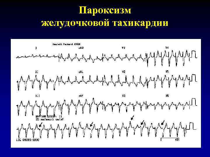 Пароксизм желудочковой тахикардии 