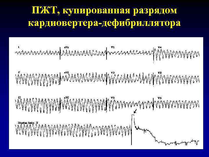 ПЖТ, купированная разрядом кардиовертера-дефибриллятора 