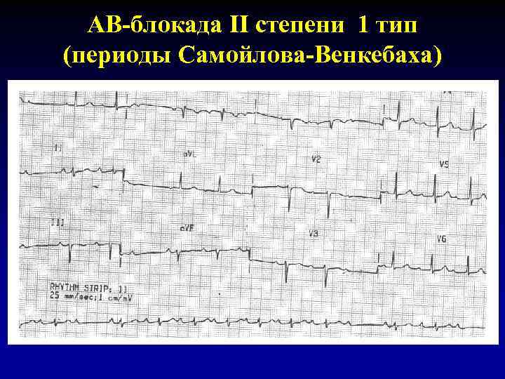 Блок схема классификация аритмий