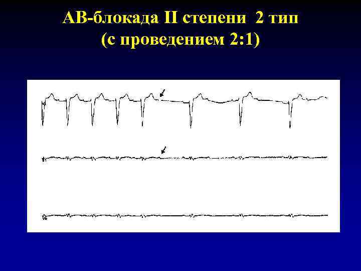 АВ-блокада II степени 2 тип (с проведением 2: 1) 