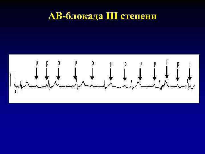 Блок схема классификация аритмий