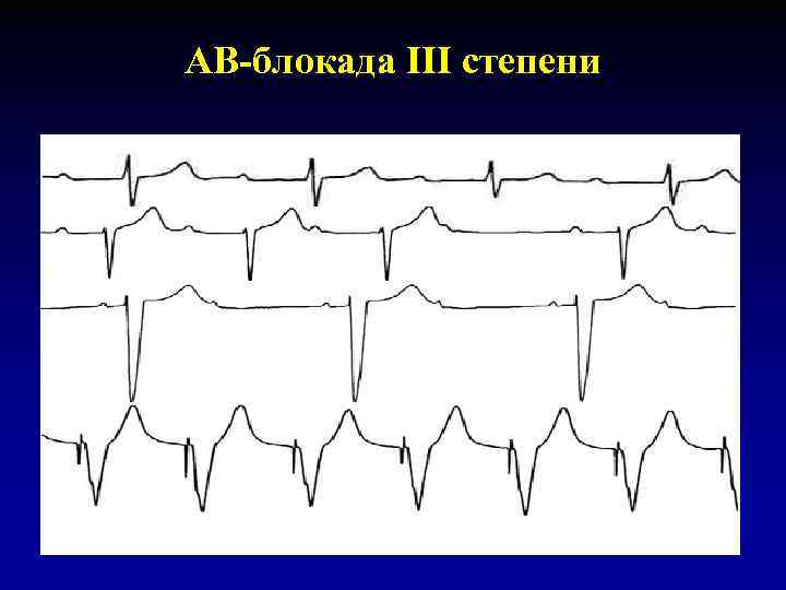 Блок схема классификация аритмий