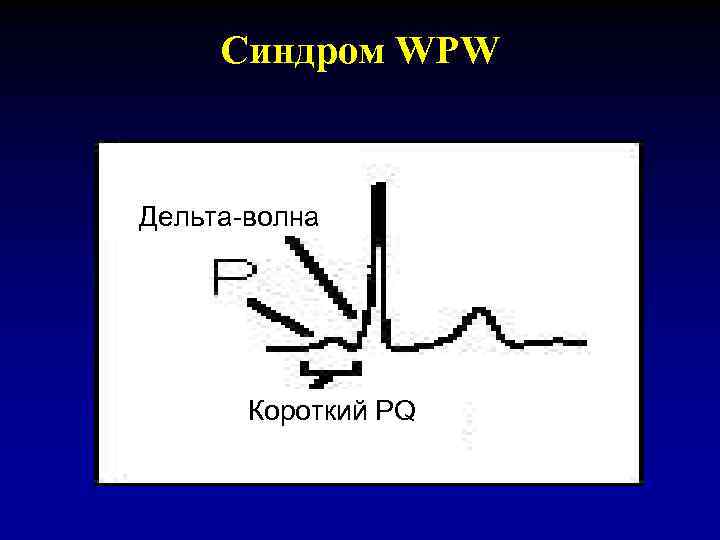 Синдром WPW Дельта-волна Короткий PQ 