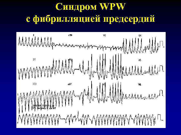 Синдром WPW с фибрилляцией предсердий 